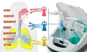 Ингалятор компрессорный LD-210C Little Doctor